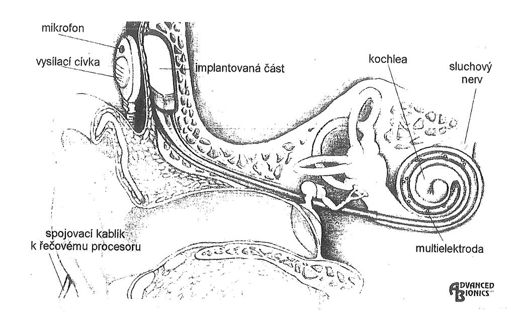 Přílohy Příloha 4 Implantabilní část kochleárního implantátu Nucleus CI24M, Implantovaná část a vysílací cívka kochleárního implantátu (Clarion) Implantabilní část kochleárního implantátu Nucleus