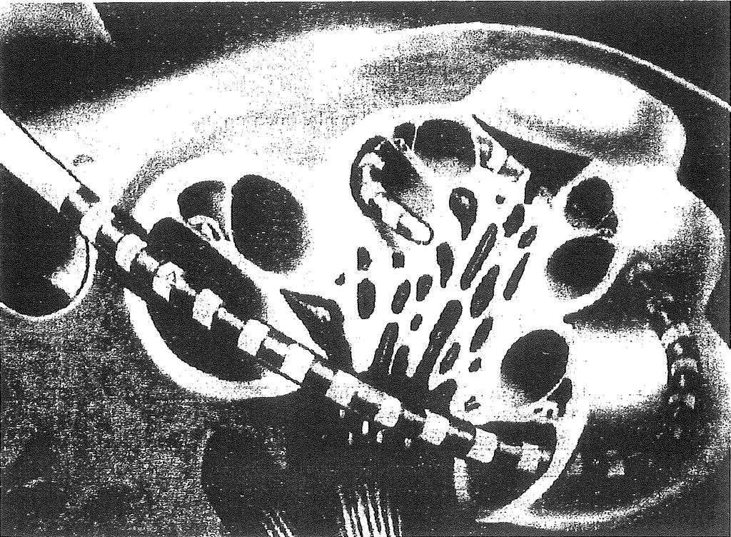 Přílohy Příloha 5 Umístění multielektrody v hlemýždi (Nucleus), Fotografie multielektrody Umístění