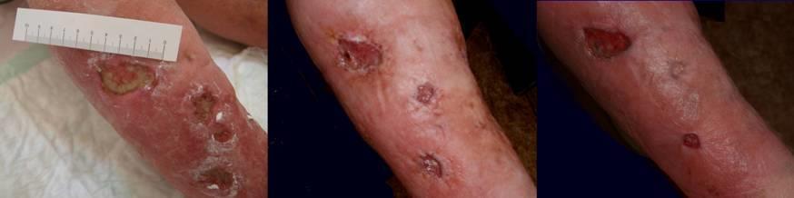 7. Kazuistiky Krytí ran StopBac bylo klinicky testováno na Klinice dětské a dospělé ortopedie a traumatologie 2.