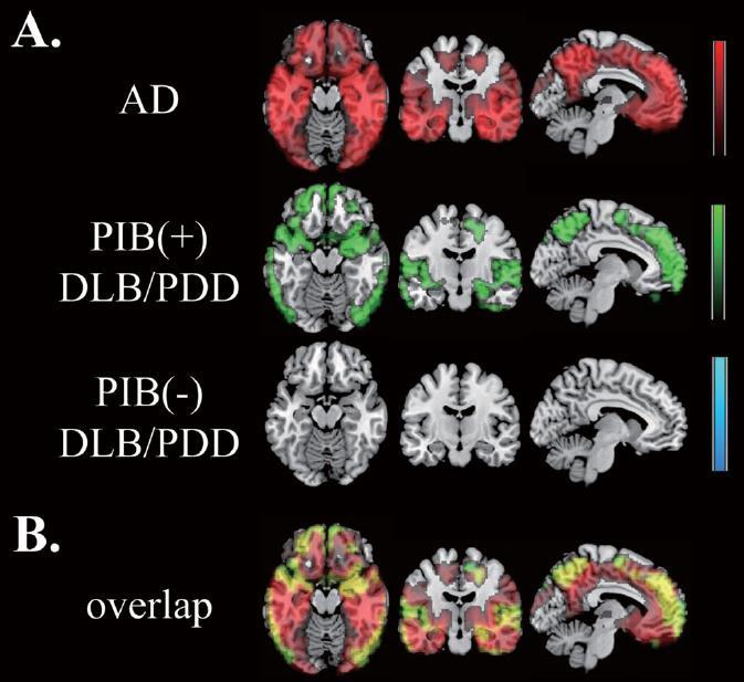 amyloid-pozitivních DLB/PDD/AD