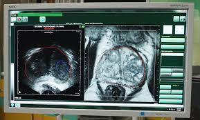 Nové trendy v biopsii prostaty fúzní biopsie prostaty: propojení NMR prostaty s TRUS navigovanou biopsií MRI je zobrazovací metoda s