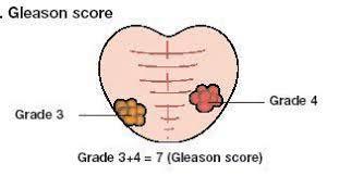 Gleasonovo skóre (GS) sytém hodnotící stupeň diferenciace nádorů prostaty na základě architektoniky žlázek na stupnici 1 5 součet dvou nejhorších hodnocení několika bioptických vzorků, může nabývat