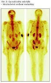 Klinický staging stanovení diagnózy T staging (ohraničení tumoru v orgánu): DRE+ TRUS, PSA, výsledek biopsie,