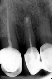 Non surgical management of cutaneous sinus tract of odontogenic origin: A case report. J Dent Oral Hyg, 2014, 6(3): 30 35. 2. Lyall BIS, Kaur J, Aggarwal I, Malhotra D, Negi M.