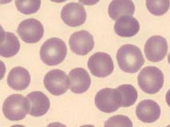 hodnotit nátěr periferní krve v souvislosti s přístrojovým KO a historií pacienta minimální běžný počet hodnocených buněk: periferní