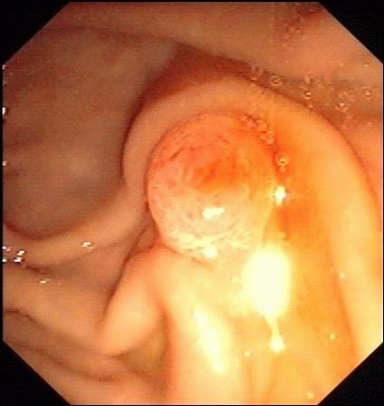 vyústění ductus choledochus + ductus pancreaticus Wirsungi papilla duodeni minor