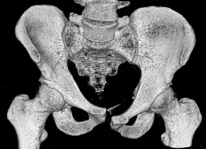 337/ Tab. 1. a kontraindikace implantace TIFI dle typů poranění Typ poranění dle AO 61-C1.1 61-C1.2 61-C1.3 61-C2.1 61-C2.2 61-C2.3 61-C3.1 61-C3.2 61-C3.