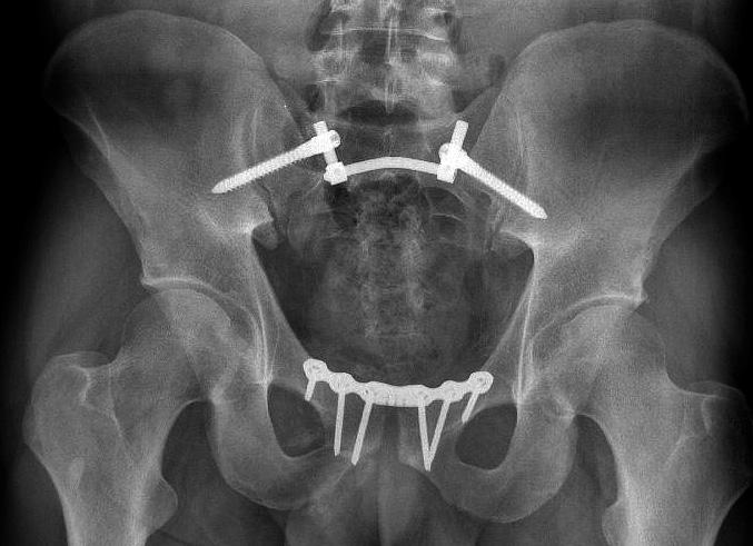 Poté jsme preparovali tupě až ke kortikalis zadní plochy lopaty kosti kyčelní, paralelně s linea glutea posterior.
