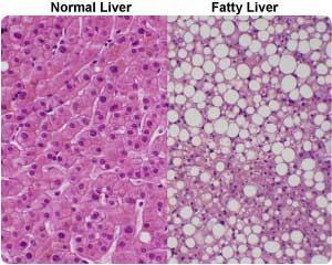 Steatóza z mitochondriální insuficience Alkoholická steatóza, steatohepatitis X Nealkoholická steatóza jater (NAFLD) dle několika studií nezávislý rf pro vznik aterosklerózy (KVS onem.