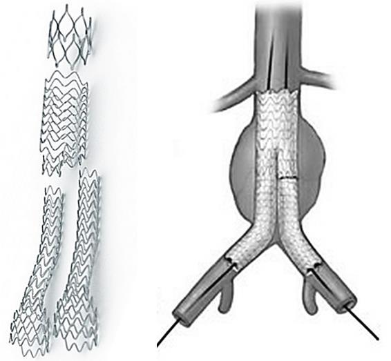 2. Aortální aneurysmata a reologie krve [1]. V případě endovaskulární léčby je oblast s aneurysmatem vyztužena stentem (obr. 1), který se zavádí katetrem skrz femorální tepnu.