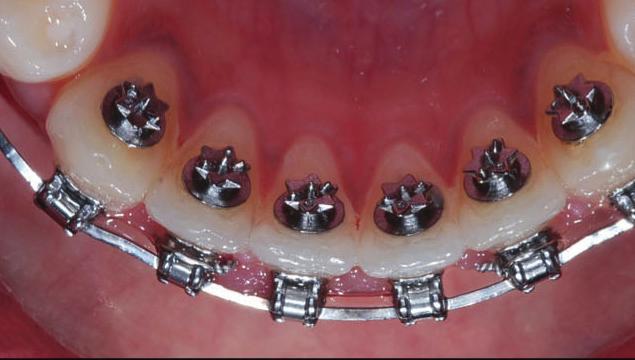3b Obr. 4a Obr. 4b ními zuby v průběhu uzavírání skusu. Při nasazení použijeme 12 TS2, aktivní samoligovací zámky s novými NiTi iarch oblouky.018.014 (SIA Orthodontics).