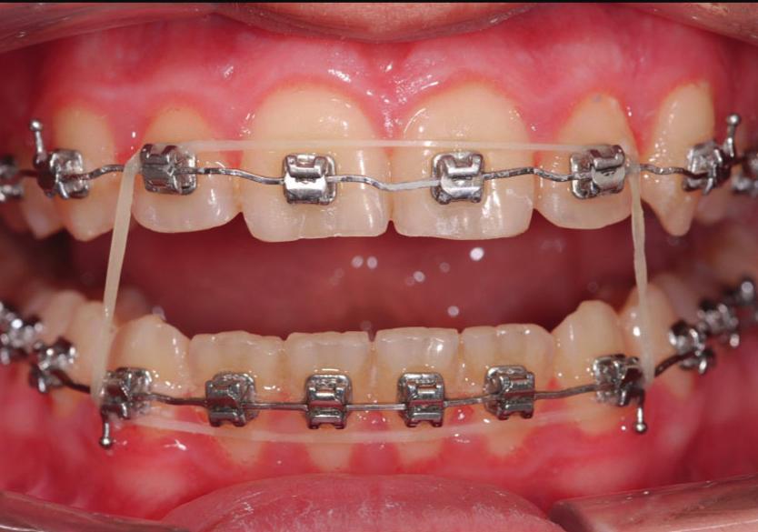 6a nou silné (6,5 mm MEDIUM). Zabraňují vkládání jazyka a umožňují rozvinutí horního zubního oblouku.