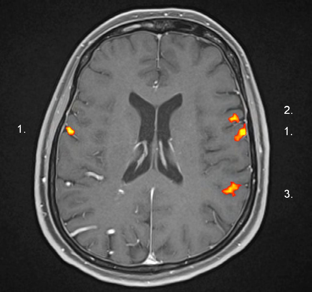 LISTY KLINICKÉ LOGOPEDIE 2/2018 24 Obrázek 2: Ukázka nejčastějšího běžného obrazu aktivací motorických oblastí jazyka v obou hemisférách a řečových center v levé dominantní hemisféře (1.