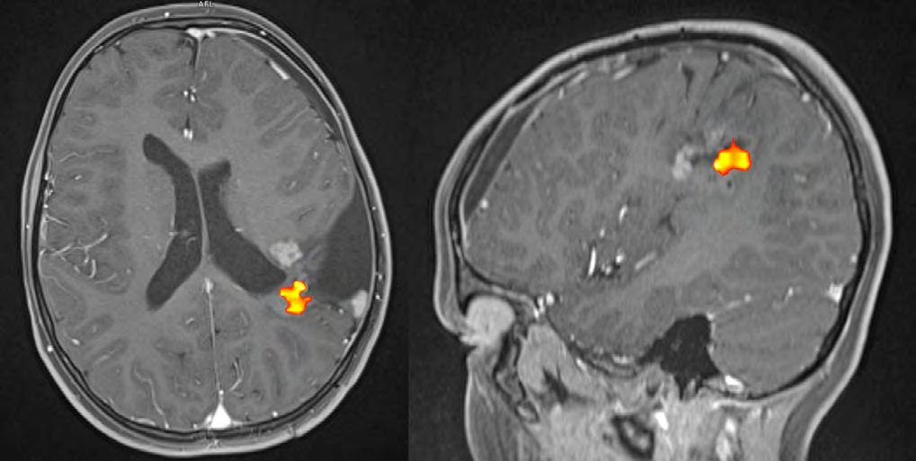LISTY KLINICKÉ LOGOPEDIE 2/2018 25 Obrázek 3: Dětský pacient po opakovaných resekcích ependymomu levé hemisféry temporoparietálně, aktivita senzorického