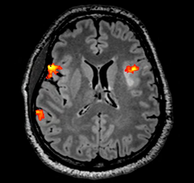 normálnímu stavu dislokováno mediálně Obrázek 4: Pacient s dominantní aktivitou při řečových zkouškách v pravé mozkové hemisféře, aktivita se však