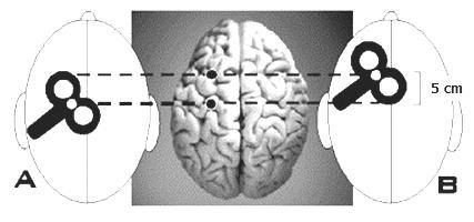 interindividuální korovou variabilitu anatomickou a funkční doposud převažuje použití nepřímé lokalizace, která využívá kombinace údajů o funkčně definované pozici nad motorickým kortexem (s