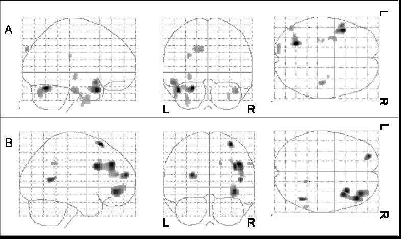 Obrázek 2B. Účinek nízkofrekvenční rtms na mozkový metabolismus dle PET. A. Nejvýraznější snížení vychytávání 18 FDG bylo detekováno v levém horním temporálním gyru a cerebelu. B.