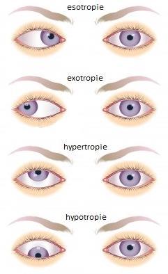15 Konkomitantní strabismus se dále dělí na konvergentní (esotropie), divergentní (exotropie), vertikální (sursumvergentní a deorsumvergentní), a zvláštní formy strabismu.