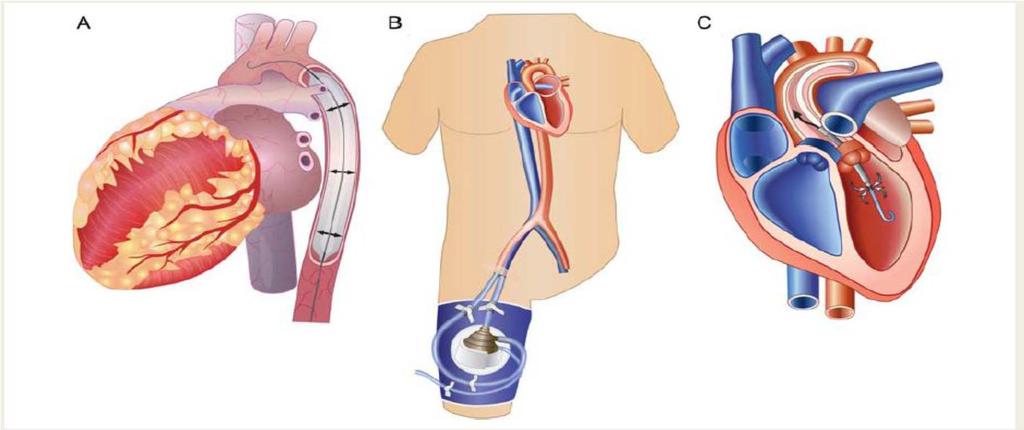 na onkologii VFN od 6/2010 postupně progredující dušnost 8/2010 zjištěna v průběhu hospitalizace ve VFN dysfunkce LKS a plicní embolizace následně terapie