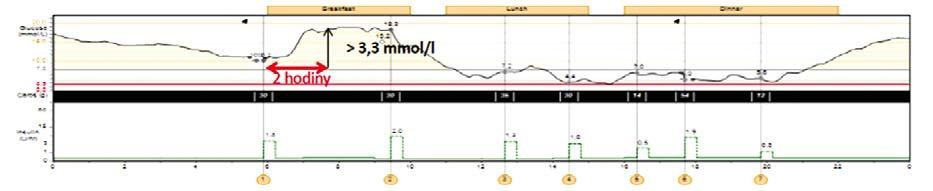 Obr. 1. Zobrazení dat stažených z inzulinové pumpy Minimed Paradigm VeoTM při systému SAP.