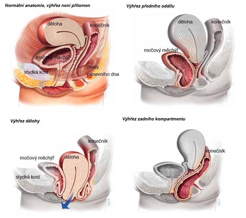 Obr. 1 Normální pozice pánevních orgánů a prolaps jednotlivých oddílů pochvy zdroj: https://www.yourpelvicfloor.org/media/pelvic-organ-prolapse-czech.pdf, cit. 9. 4.