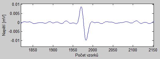 6.2.2 Odstranění mrknutí Po filtraci bylo nutné odstranit rušivé aspekty, jako je mrknutí. Průměrná doba trvání mrknutí je 100 až 400 ms.