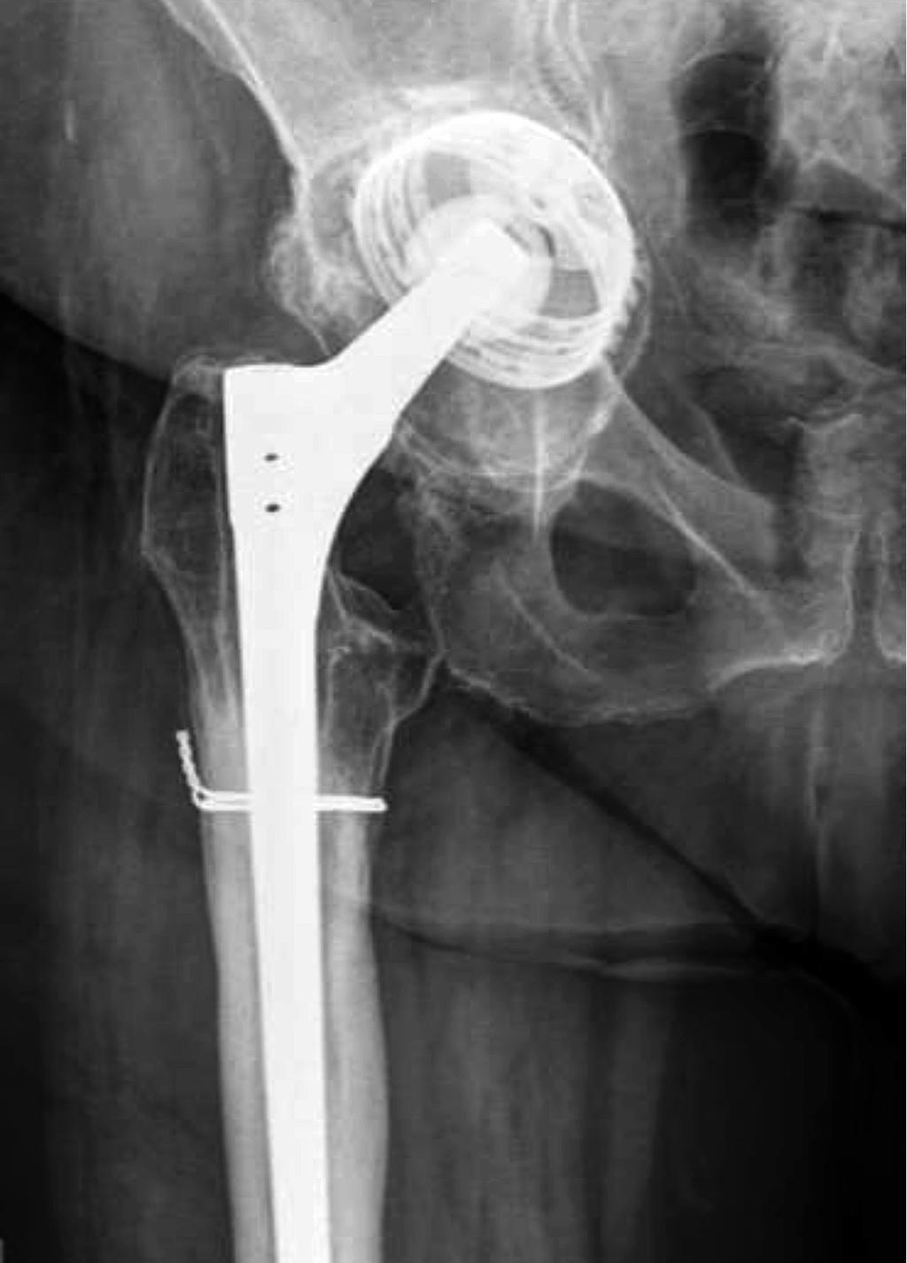 160/ Acta Chir Orthop Traumatol Cech. 84, 2017, No.