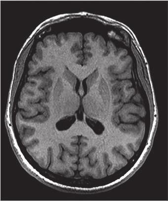 a Obr. 1. MR obraz atrofie caput nuclei caudati u HN oproti zdravému mozku. a) zdravý člověk, b) nemocný člověk (Zapůjčeno prof. MUDr. J. Vymazalem, DrSc., oddělení MR, Nemocnice Na Homolce, Praha.