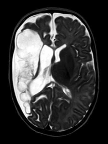 10 Hlavná téma Obr. 1. Rozsáhlá cystická encefalomalacie pravé mozkové hemisféry, kopírující povodí a. cerebri media (MRI, T2-vážené zobrazení) Obr. 2.