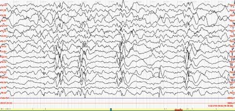 Kontinuální hypsarytmie (bdělost, longitudinální zapojení, osm měsíců věku) lem 10 % (Carpay et al., 1998), dle novějších prací dokonce mezi 3 9 % (Holland et Glauser, 2007).