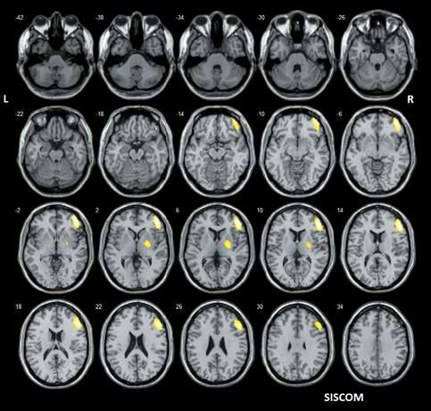 12 Hlavná téma Obr. 7. SISCOM (koregistrace subtrakčního iktálního SPECT s MRI) lokalizuje pravostranně premotoricky Obr. 8.