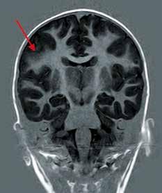 13 Obr. 10. MRI mozku, true inversion recovery, koronární rovina hemisferektomie se pohybuje mezi 61 80 % (Baumgartner et al.