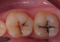 Zubní technici postupují stejnou metodou stratifikace jako při práci s keramickými materiály. Preparace Preparace musí být bez podsekřivin.