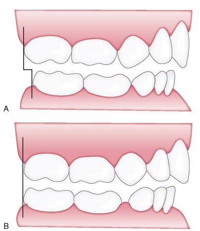 Rozdíly ve stavbě ve stálé a dočasné dentici H i D oblouk končí v jedné rovině ( při