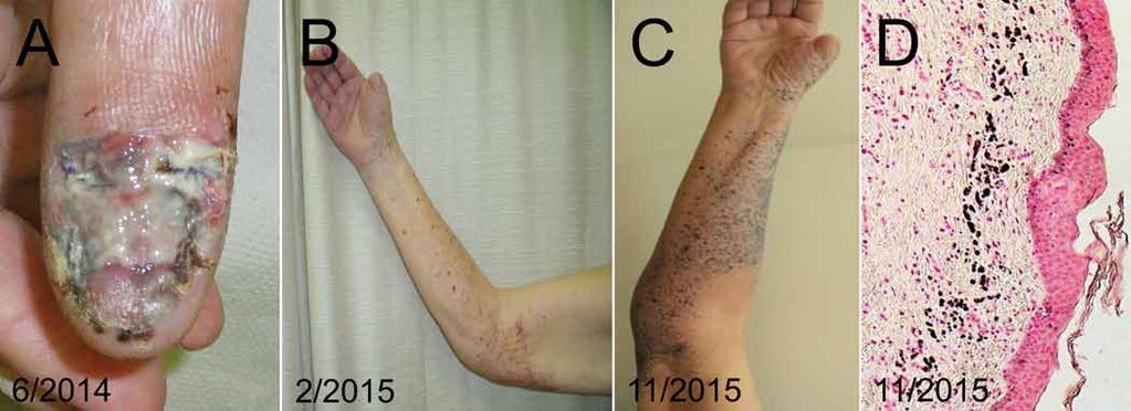 Obr. 5. Pacient, 89 let, s lokálně pokročilým melanomem palce pravé ruky.