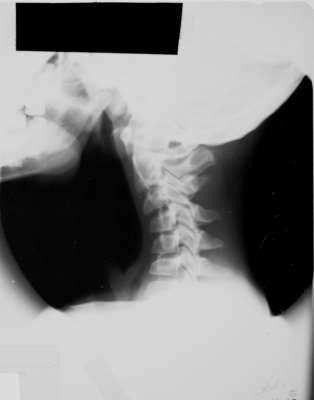 Anatomické rozdíly Krční páteř Měkká spinální ligamenta Klínovitý tvar přední části těla obratle Ploché fazety kloubů Pseudosubluxace