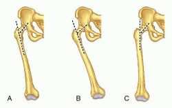 68 zesílení kosti v medio-laterální rovině, což se projeví v šíři kondylů (i epikondylů).