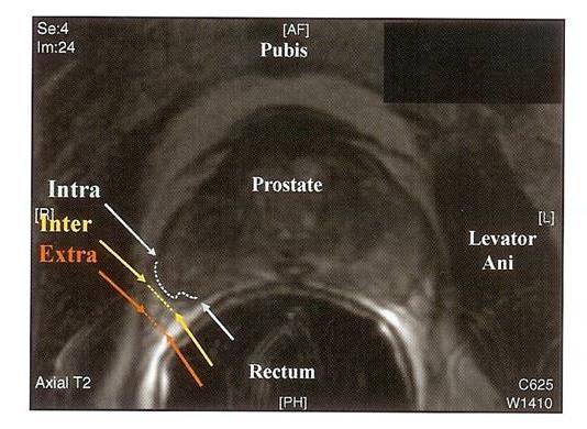 Anatomické hranice nové