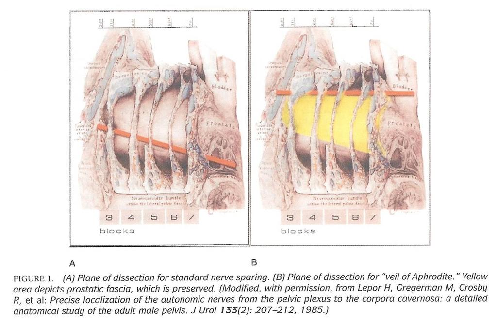 Technika výkonu - Veil of Afrodita Preservace prostatické fascie (Afroditin závoj)