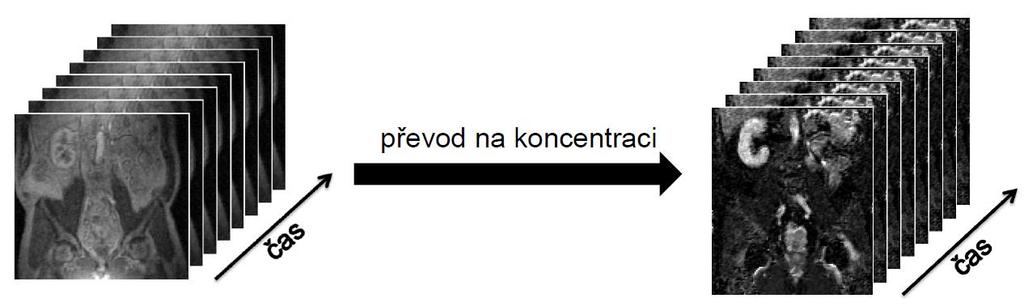 Obr. 1.2 Převod na koncentraci k.l. Průmětem skrz veškeré takto získané obrazy dynamické sekvence lze získat křivku koncentrace k.l., Obr. 1.3. Obr. 1.3 Zisk křivky koncentrace k.l. z dynamické sekvence Právě tyto křivky koncentrace kontrastní látky v ROI jsou základem pro následnou perfúzní analýzu.