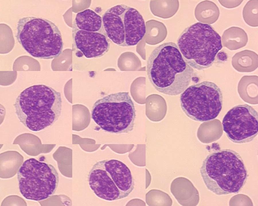 laboratorní nález: Lymfom z plášťových buněk (MCL) morfologie nádorových buněk: bývají polymorfní,