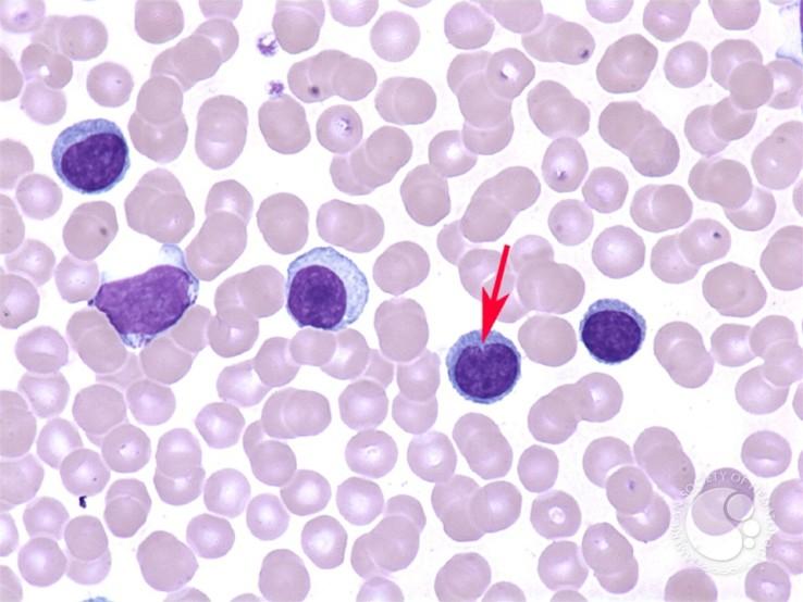 laboratorní nález: T prolymfocytární leukémie