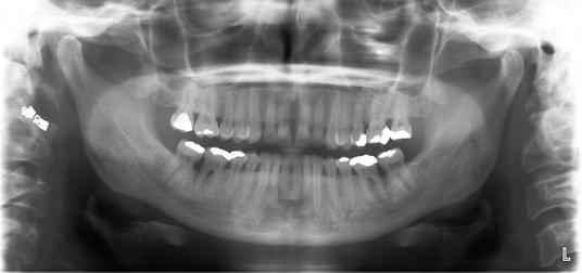 22 MALÉ ILUSTROVANÉ REPETITORIUM Obr. 10: Ortopantomogram zhotovený při kontrole po 18 měsících od provedení výkonu. Obr. 10 žádoucí (7).