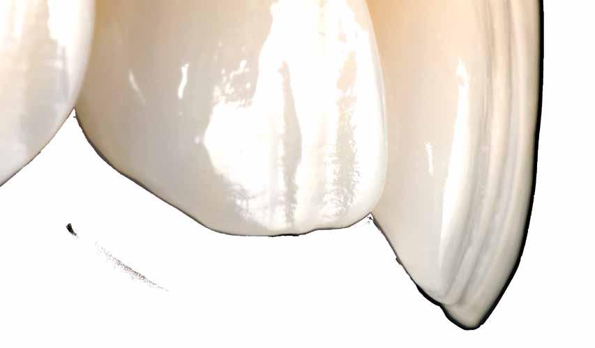 IPS Empress Direct Vysoce