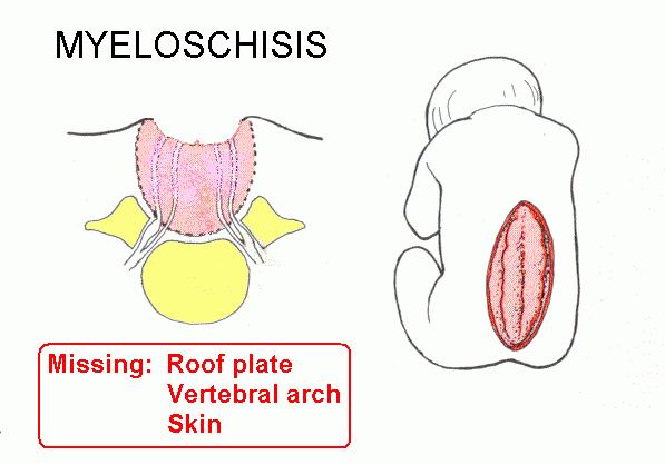 4. Myeloschisis Kompletní dorzální rozštěp míchy vzniklý následkem neuskutečnění neurulace Hřbetní mícha