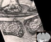 diskospondylitída - neoplazie - OCD sakrální kosti - degenerativní lumbosakrální artropatie Predispozice: - velká