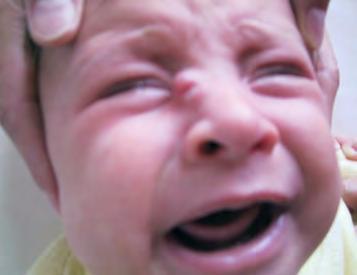 1 Vrozené anomálie hlavy a krku a fistuly nosu nejsou součástí syndromů, nejsou geneticky přenosné, ale vyskytují se i s jinými anomáliemi, kraniofaciálními anomáliemi, s hypertelorizmem, rozštěpem