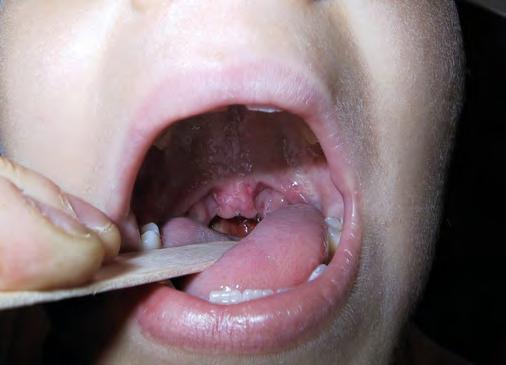 Vrozené anomálie dutiny ústní a hltanu 2 Submukózní rozštěp a uvula bifida Submukózní rozštěp patra je lehčí varianta rozštěpů patra, při které je častý rozštěp uvuly (obr. 2.4), na zadním konci tvrdého patra je prohlubeň a někdy viditelný proužek uprostřed patra jako projev svalové diastázy (7).