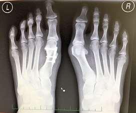 Neuvědomují si však, že je to právě čas, který hraje vléčbě velmi důležitou roli. Hallux valgus je nemoc vybočeného palce u nohou. Například bolest ramene lidé zmírňují většinou tím, že sním nehýbou.