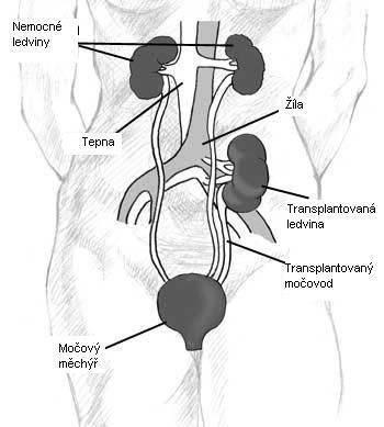 Transplantační chirurg má pro místo uložení transplantované ledviny na výběr ze dvou možností. Zda zvolí pravou nebo levou kyčelní jámu ovlivňuje několik faktorů a zvyklosti daného pracoviště.